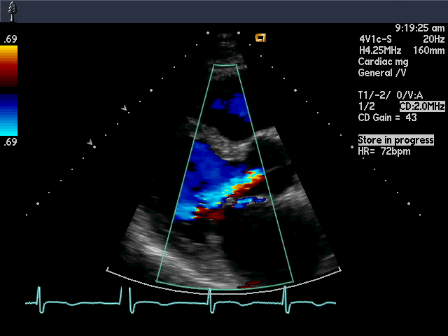 Ultraljudsbild av hjärtat där doppler använts för att visualisera flödeshastighet och flödesriktning.