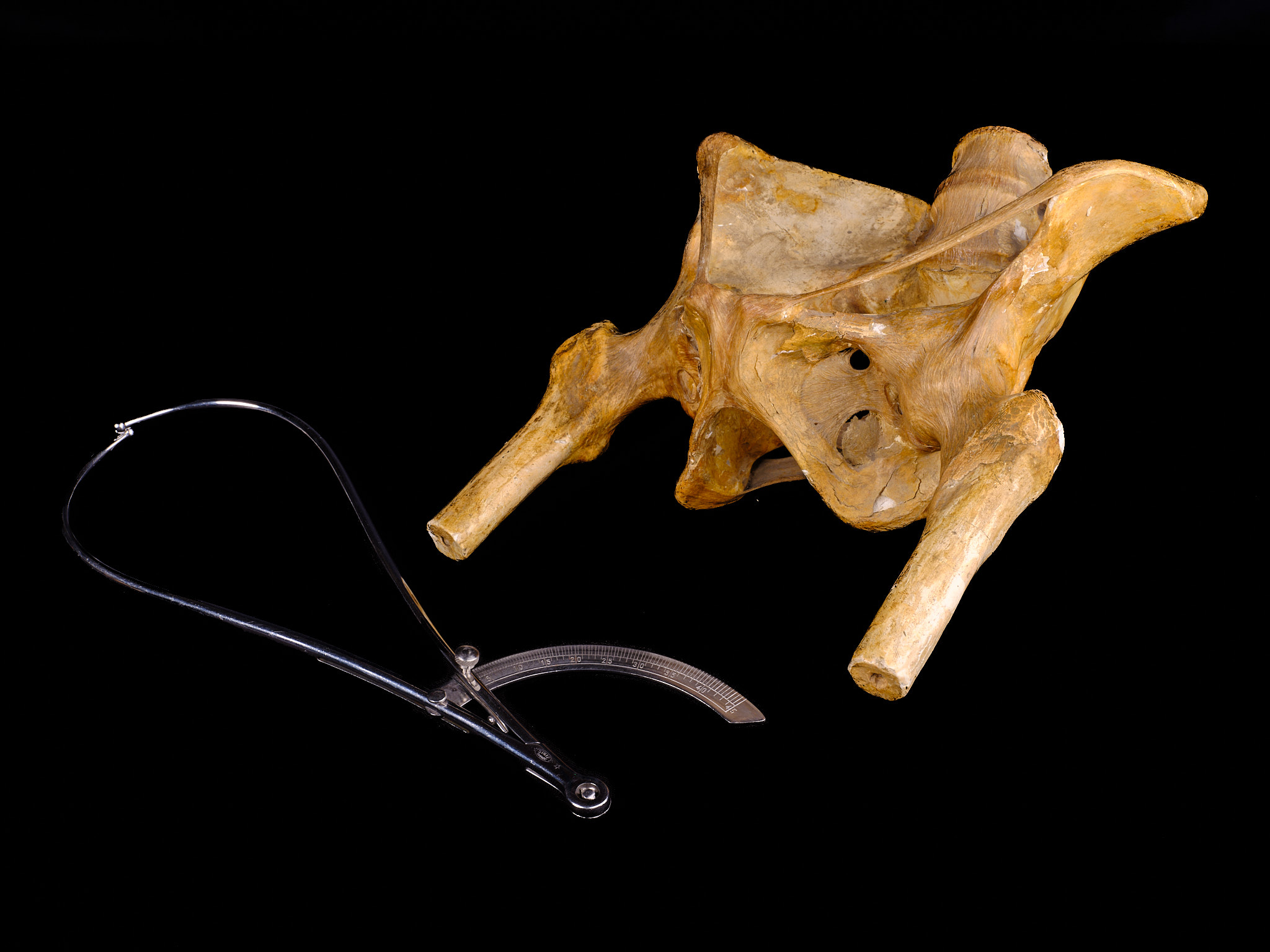 Gipsavgjutning patologiskt bäcken